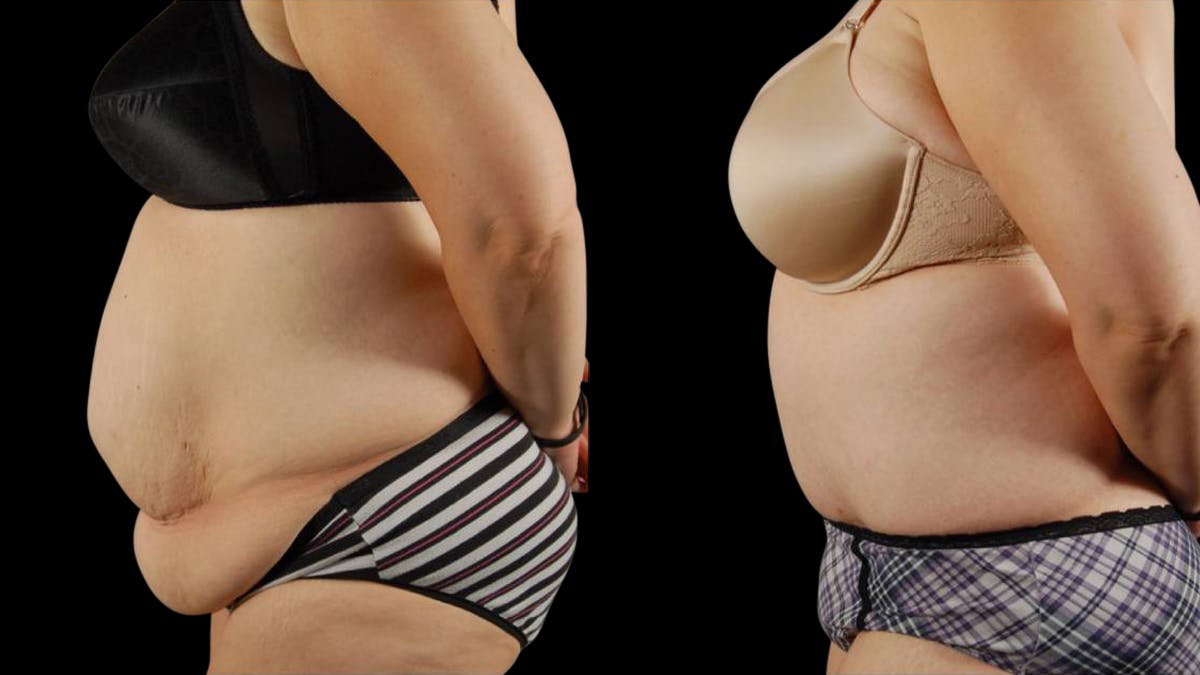 Tummy Tuck Before & After Gallery - Patient 177831 - Image 3