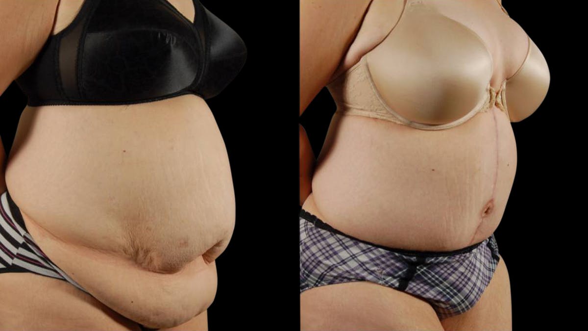 Tummy Tuck Before & After Gallery - Patient 177831 - Image 4
