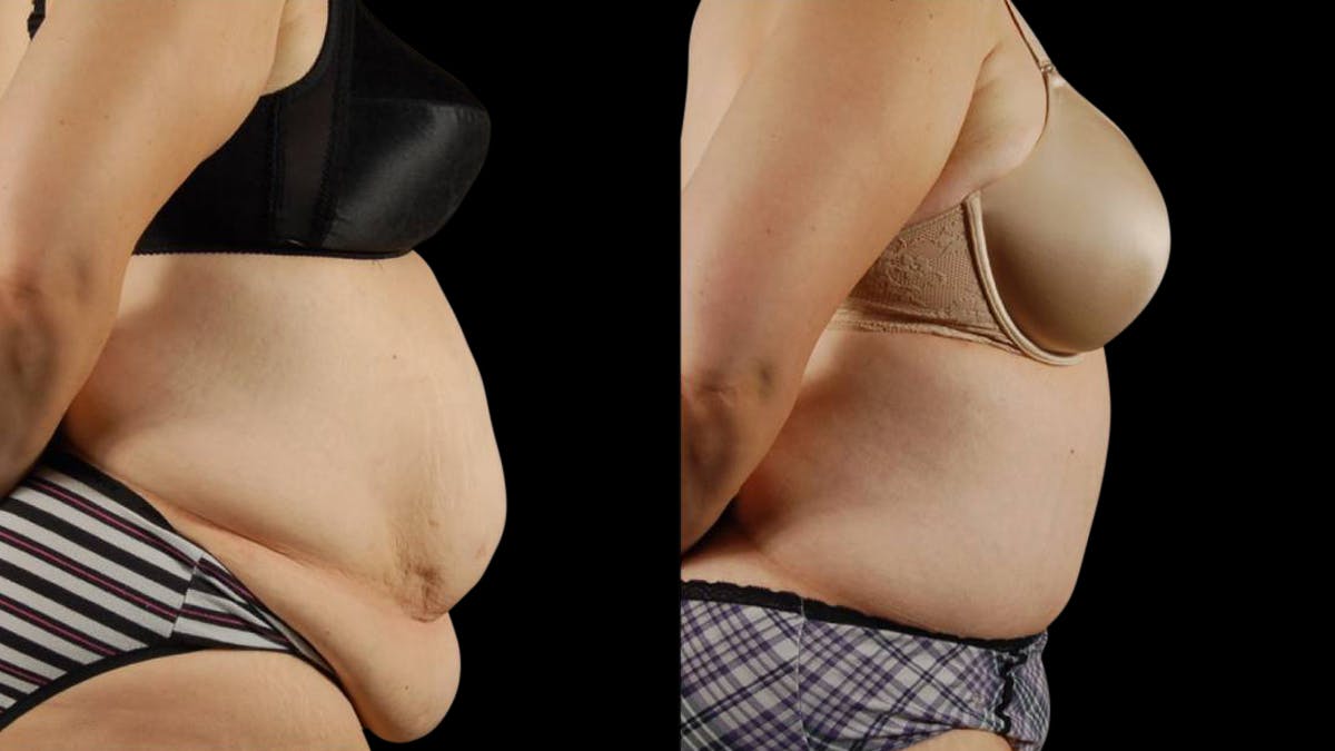 Tummy Tuck Before & After Gallery - Patient 177831 - Image 5