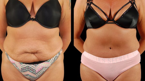 Tummy Tuck Before & After Gallery - Patient 405153 - Image 1