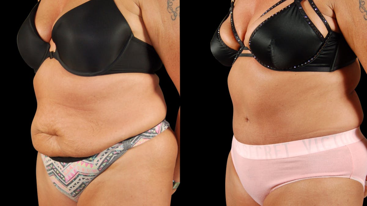 Tummy Tuck Before & After Gallery - Patient 405153 - Image 2