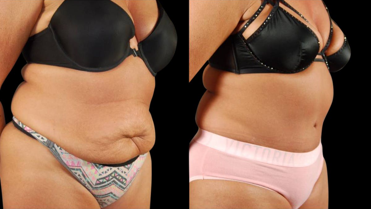 Tummy Tuck Before & After Gallery - Patient 405153 - Image 3