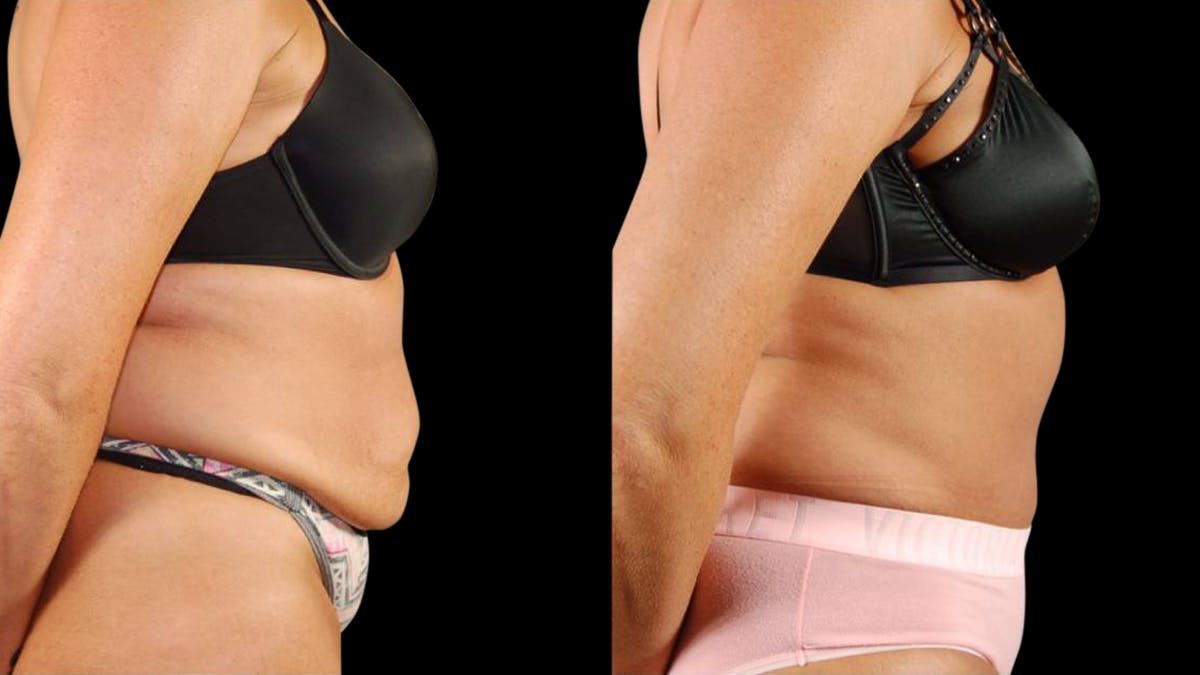 Tummy Tuck Before & After Gallery - Patient 405153 - Image 4