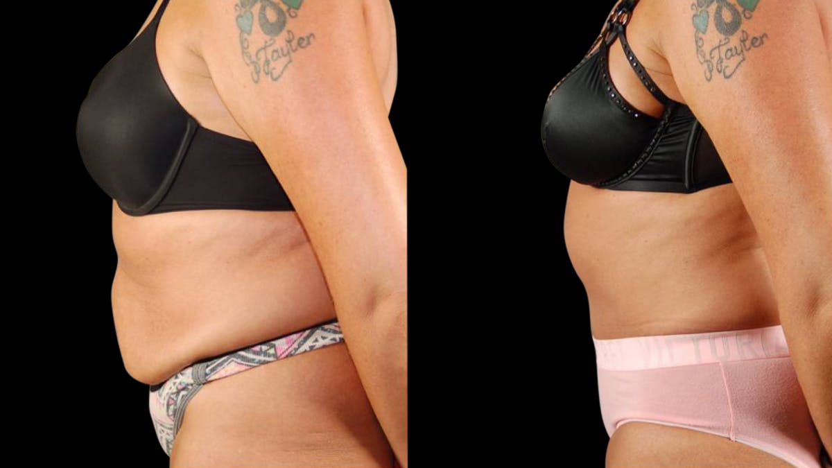 Tummy Tuck Before & After Gallery - Patient 405153 - Image 5