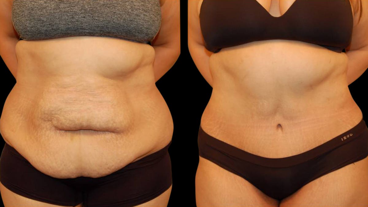 Tummy Tuck Before & After Gallery - Patient 117626 - Image 1