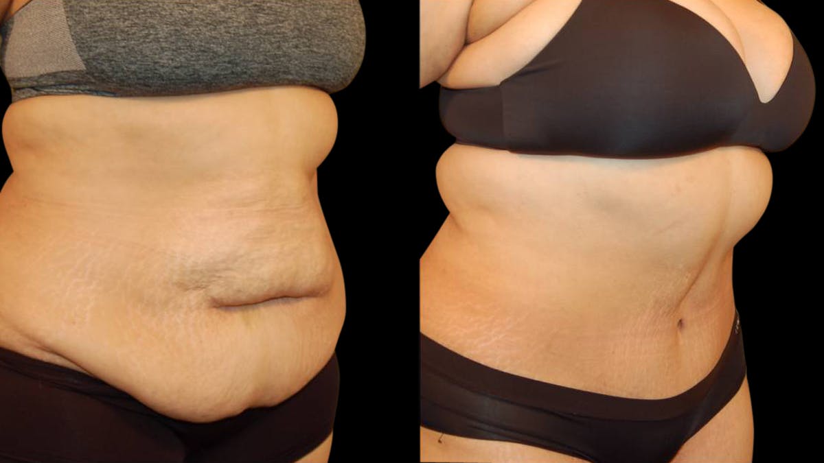 Tummy Tuck Before & After Gallery - Patient 117626 - Image 2