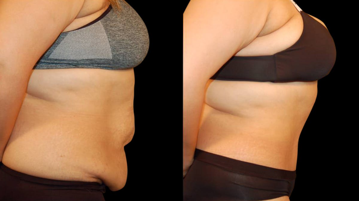 Tummy Tuck Before & After Gallery - Patient 117626 - Image 3