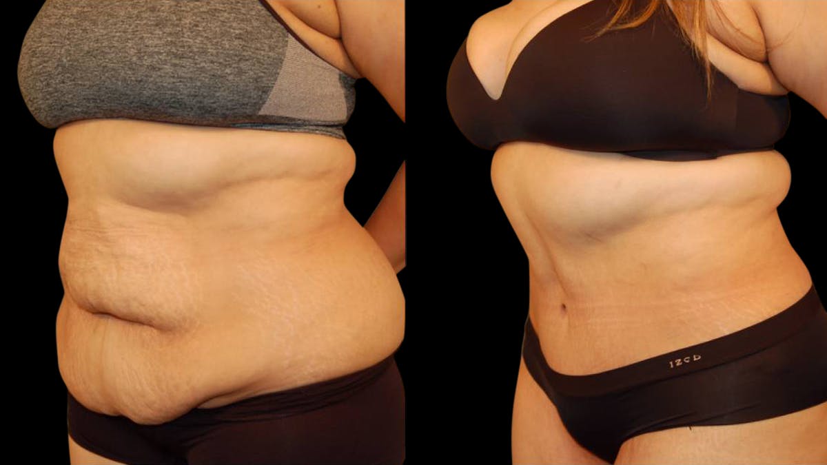 Tummy Tuck Before & After Gallery - Patient 117626 - Image 4