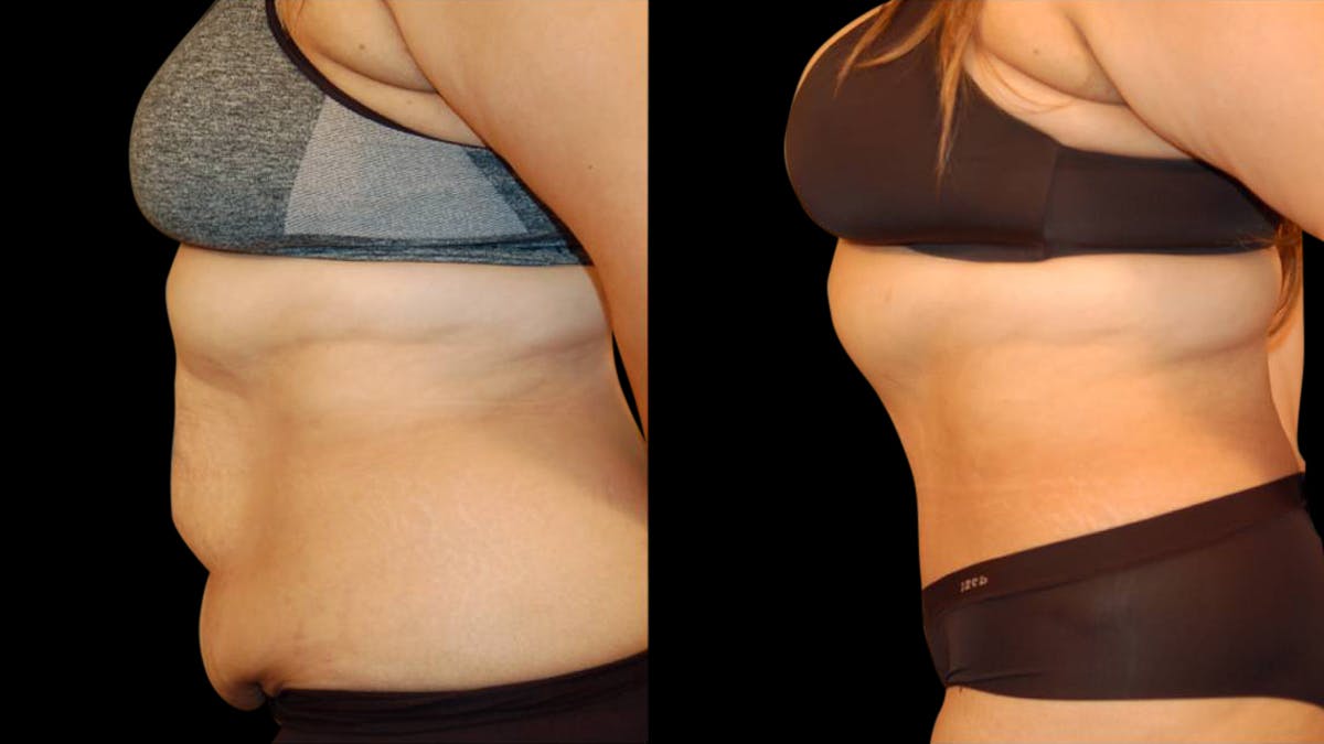 Tummy Tuck Before & After Gallery - Patient 117626 - Image 5