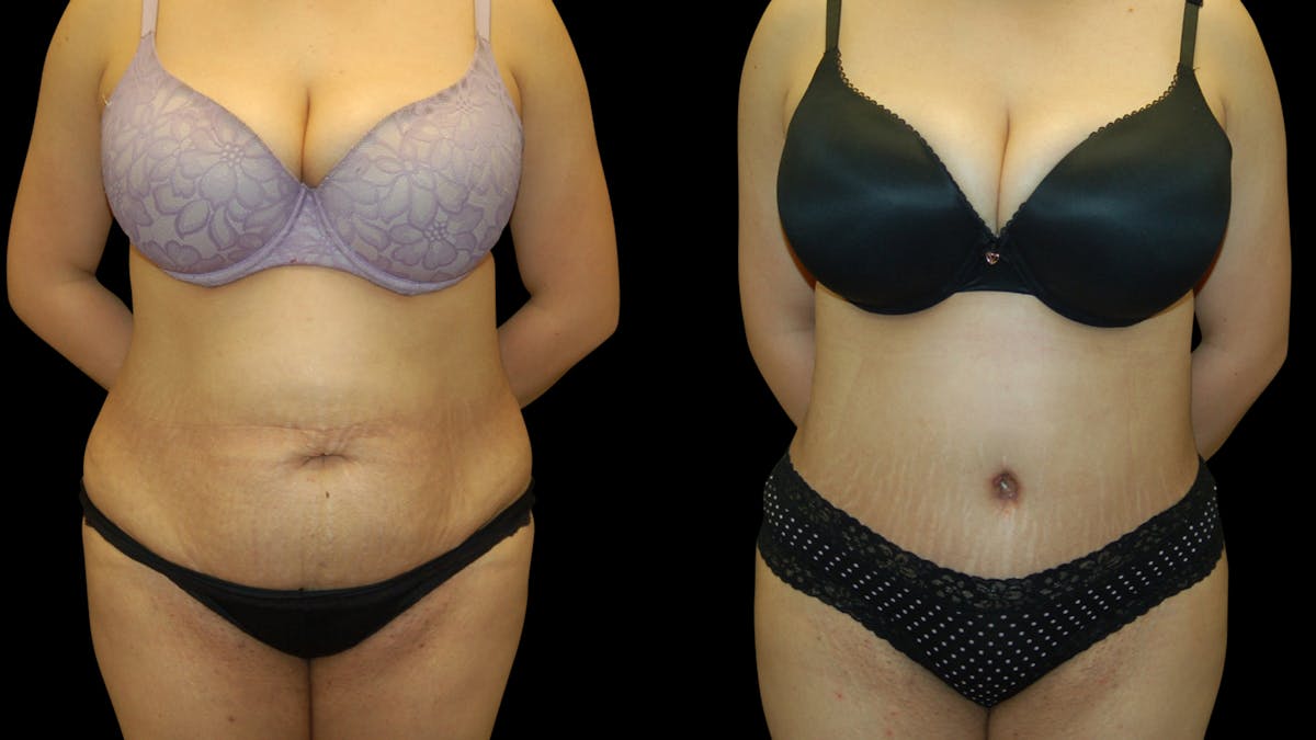 Tummy Tuck Before & After Gallery - Patient 389831 - Image 1