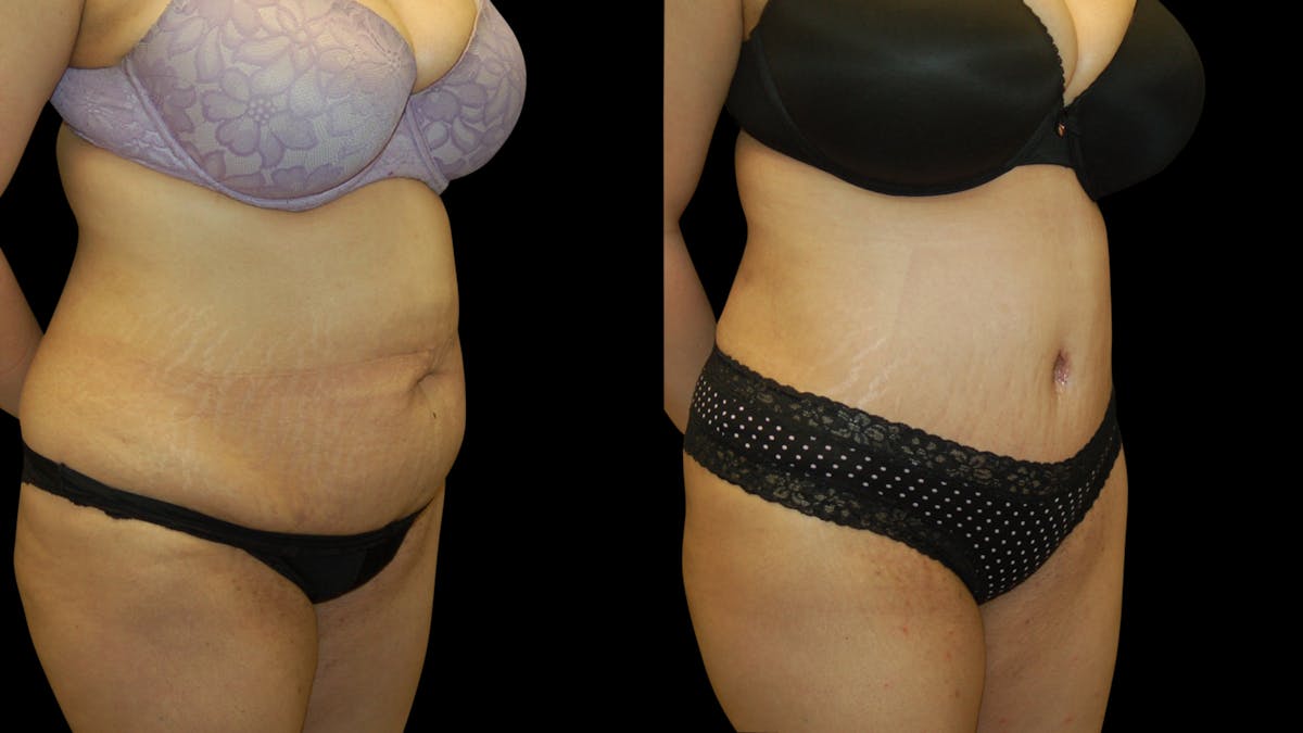 Tummy Tuck Before & After Gallery - Patient 389831 - Image 2