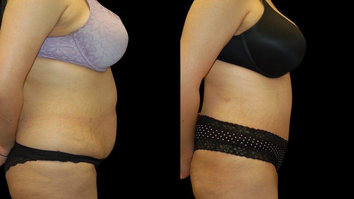 Tummy Tuck Before & After Gallery - Patient 389831 - Image 3