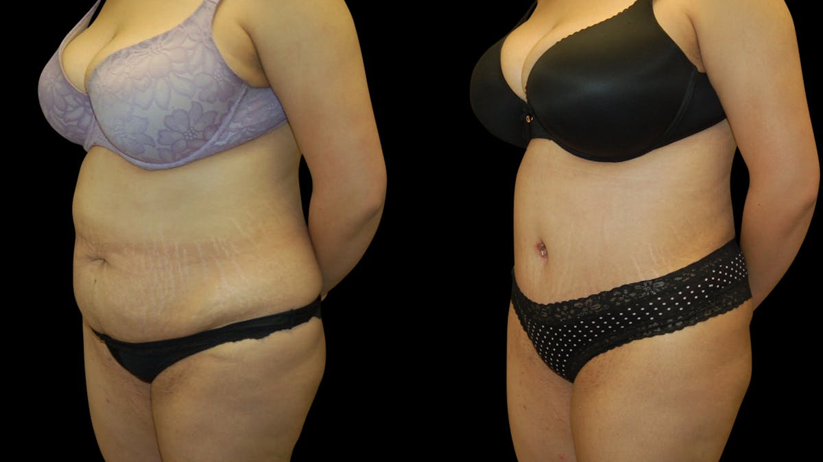 Tummy Tuck Before & After Gallery - Patient 389831 - Image 4