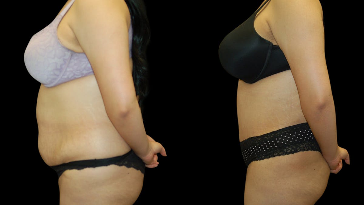 Tummy Tuck Before & After Gallery - Patient 389831 - Image 5