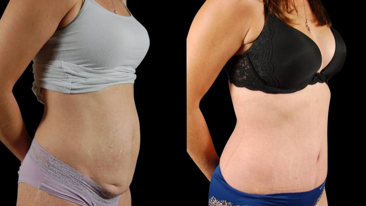Tummy Tuck Before & After Gallery - Patient 294410 - Image 1