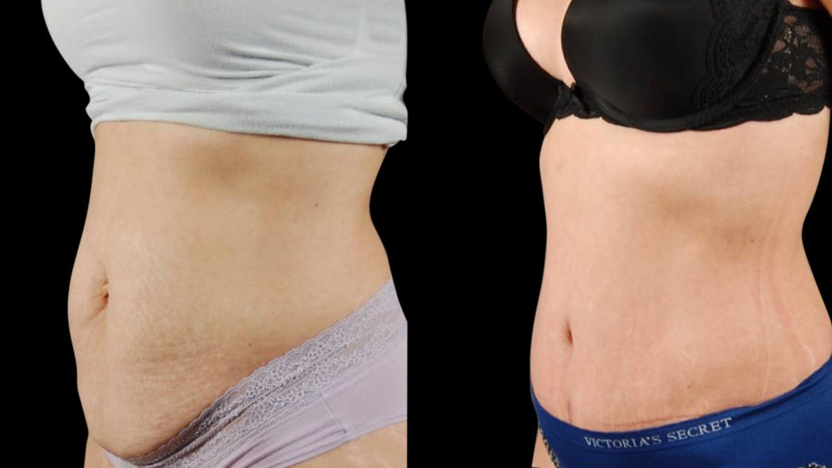 Tummy Tuck Before & After Gallery - Patient 294410 - Image 2