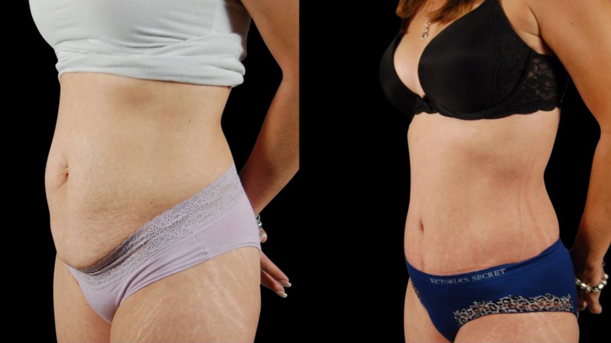 Tummy Tuck Before & After Gallery - Patient 294410 - Image 3