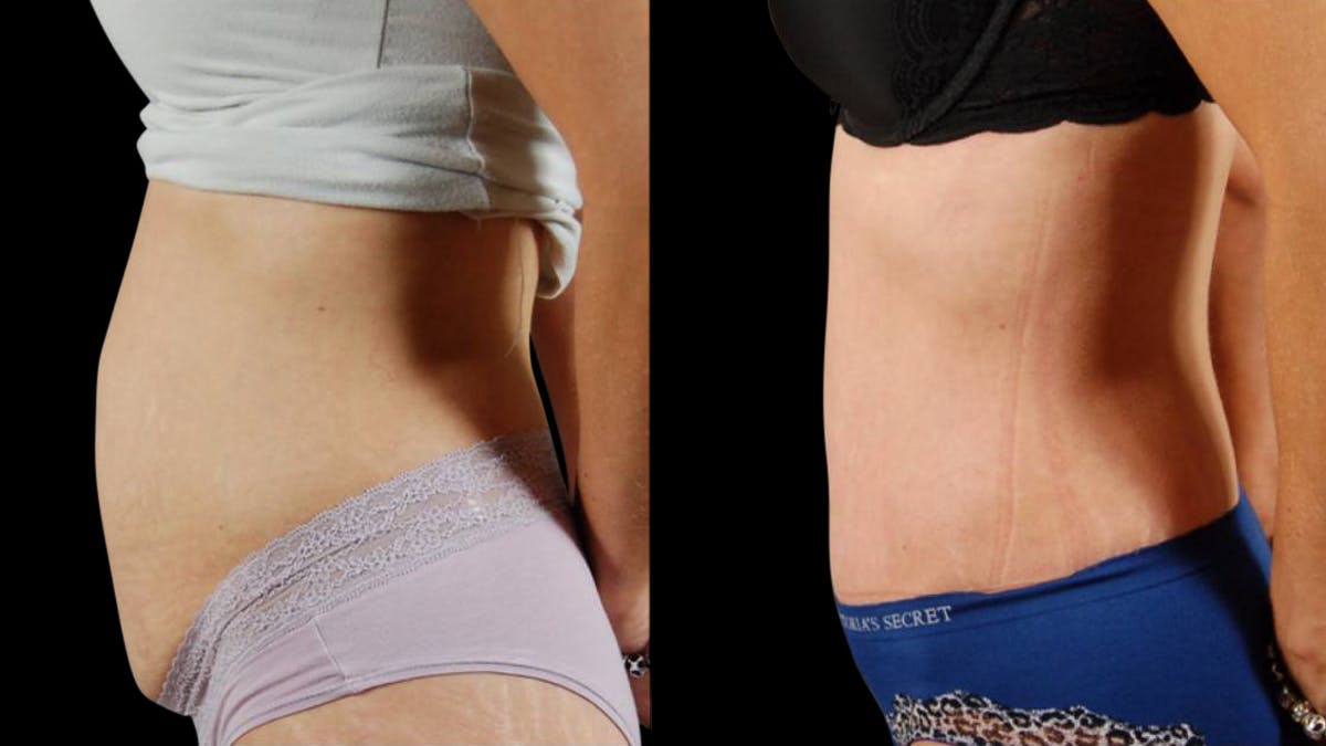 Tummy Tuck Before & After Gallery - Patient 294410 - Image 4