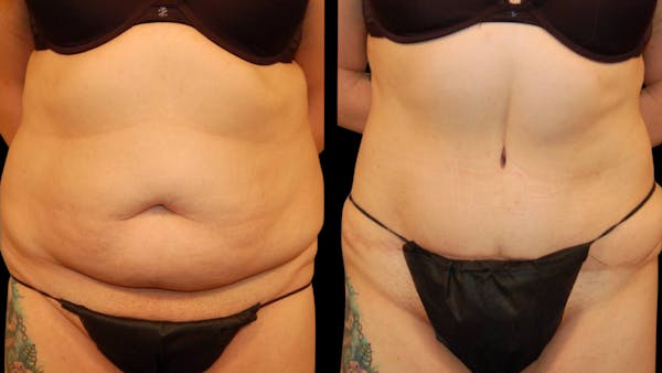 Tummy Tuck Before & After Gallery - Patient 101339 - Image 1