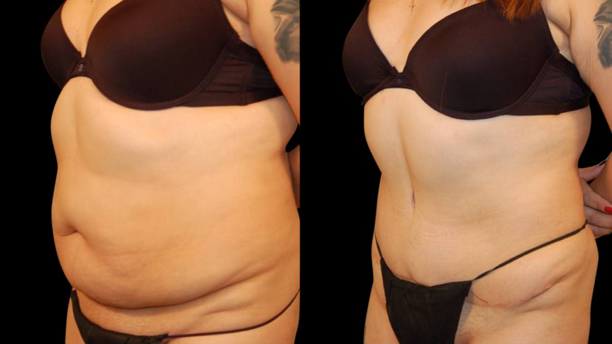 Tummy Tuck Before & After Gallery - Patient 101339 - Image 2