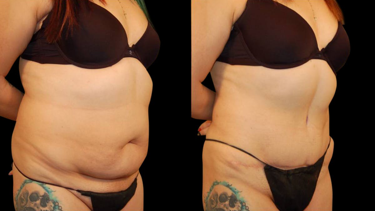 Tummy Tuck Before & After Gallery - Patient 101339 - Image 3