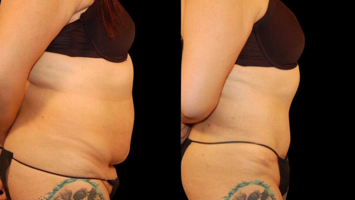 Tummy Tuck Before & After Gallery - Patient 101339 - Image 4