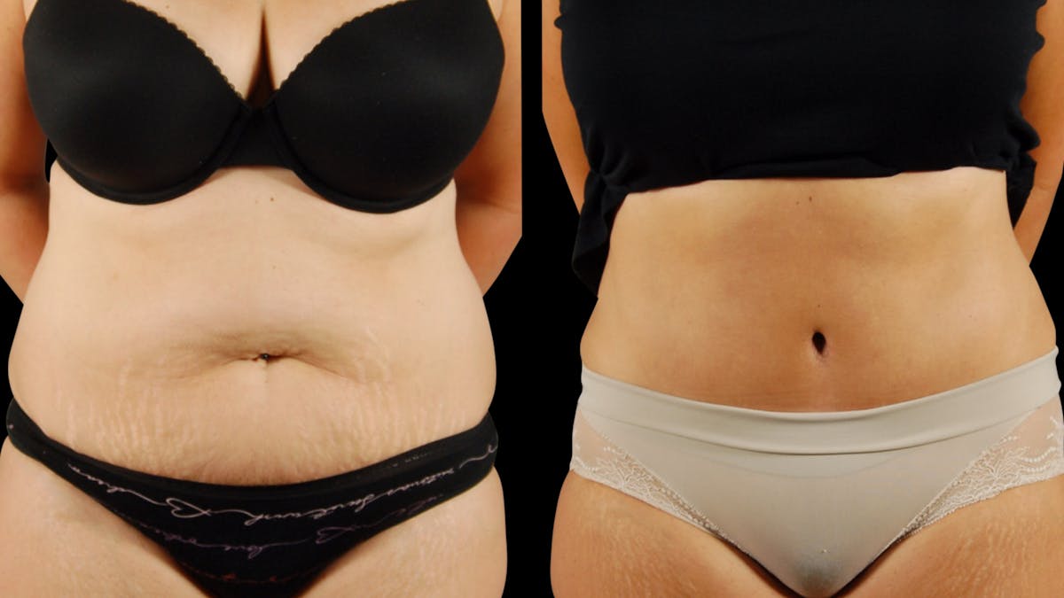 Tummy Tuck Before & After Gallery - Patient 954854 - Image 1