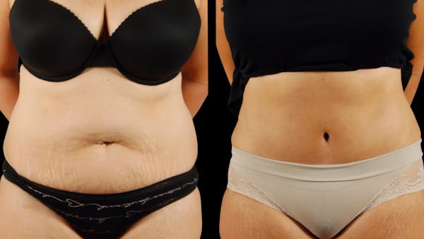 Tummy Tuck Before & After Gallery - Patient 954854 - Image 1
