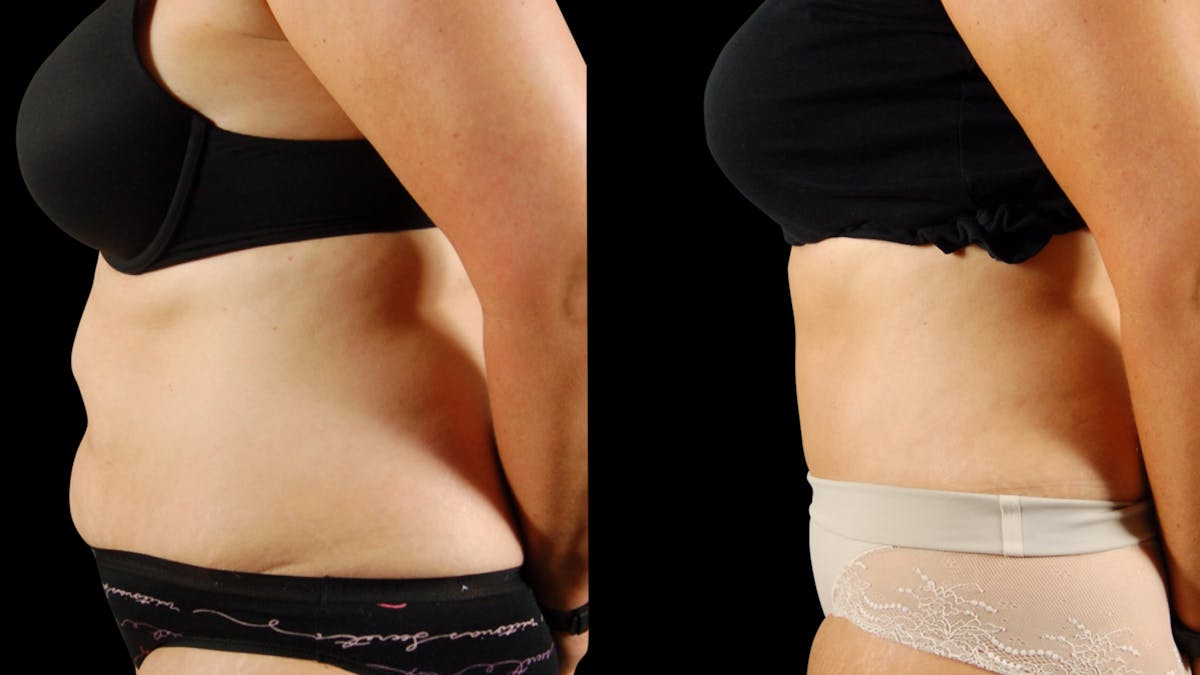 Tummy Tuck Before & After Gallery - Patient 954854 - Image 3