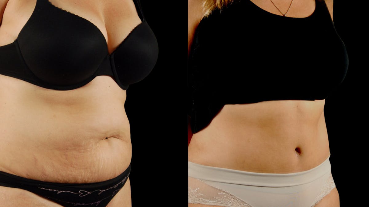 Tummy Tuck Before & After Gallery - Patient 954854 - Image 4