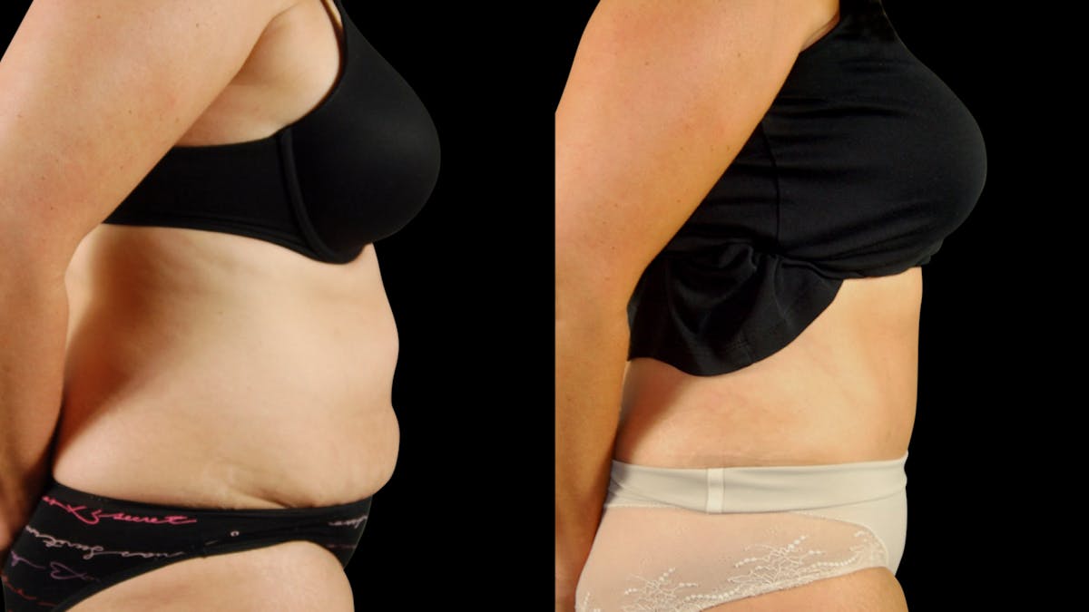 Tummy Tuck Before & After Gallery - Patient 954854 - Image 5