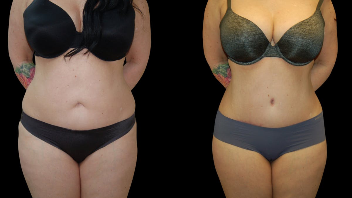 Tummy Tuck Before & After Gallery - Patient 191229 - Image 1