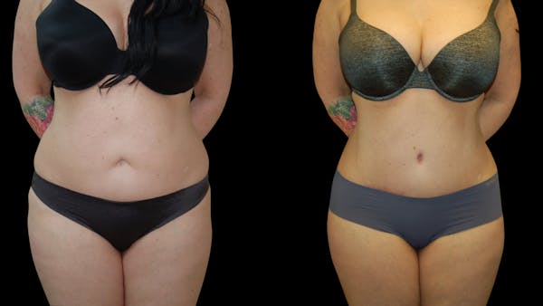 Tummy Tuck Before & After Gallery - Patient 191229 - Image 1