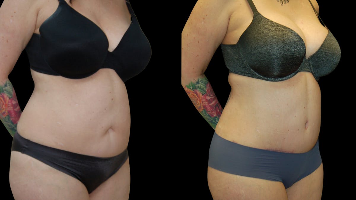 Tummy Tuck Before & After Gallery - Patient 191229 - Image 2