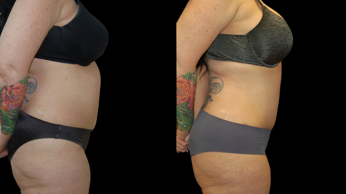 Tummy Tuck Before & After Gallery - Patient 191229 - Image 3