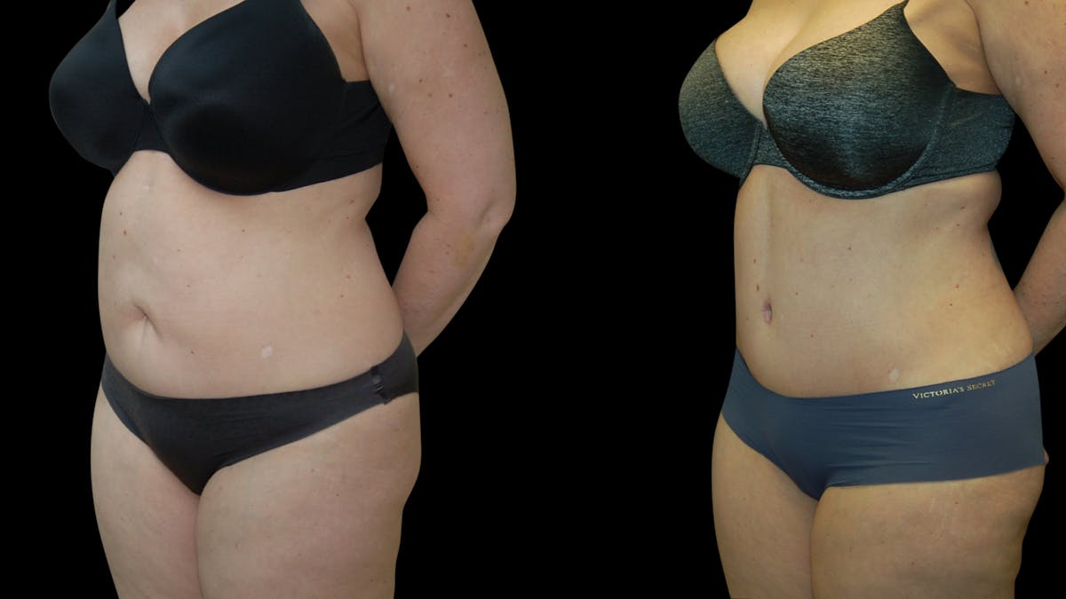 Tummy Tuck Before & After Gallery - Patient 191229 - Image 4