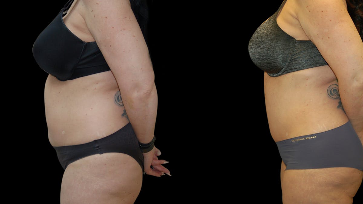 Tummy Tuck Before & After Gallery - Patient 191229 - Image 5