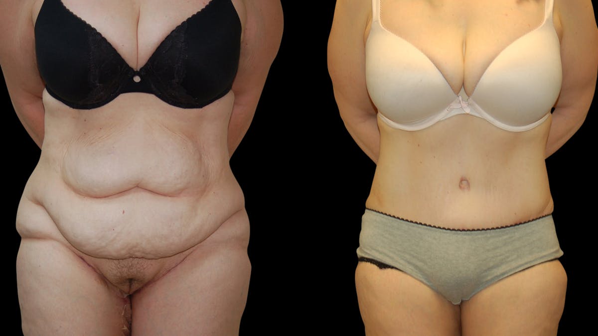 Tummy Tuck Before & After Gallery - Patient 352935 - Image 1
