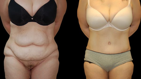 Tummy Tuck Before & After Gallery - Patient 352935 - Image 1