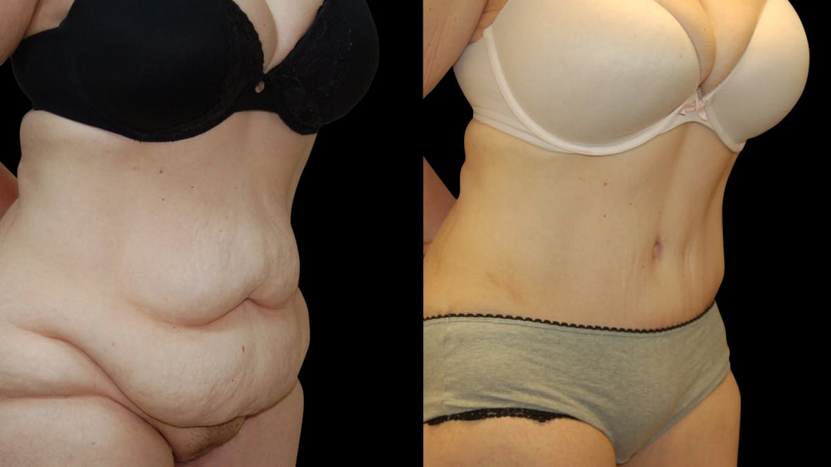 Tummy Tuck Before & After Gallery - Patient 352935 - Image 2