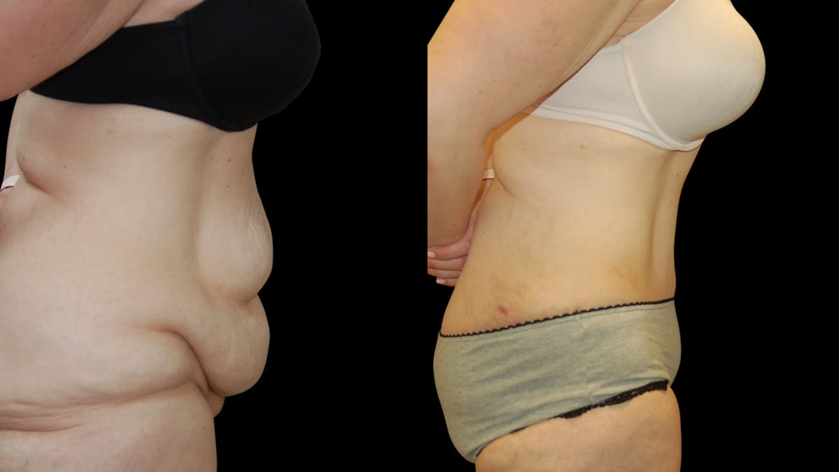Tummy Tuck Before & After Gallery - Patient 352935 - Image 3