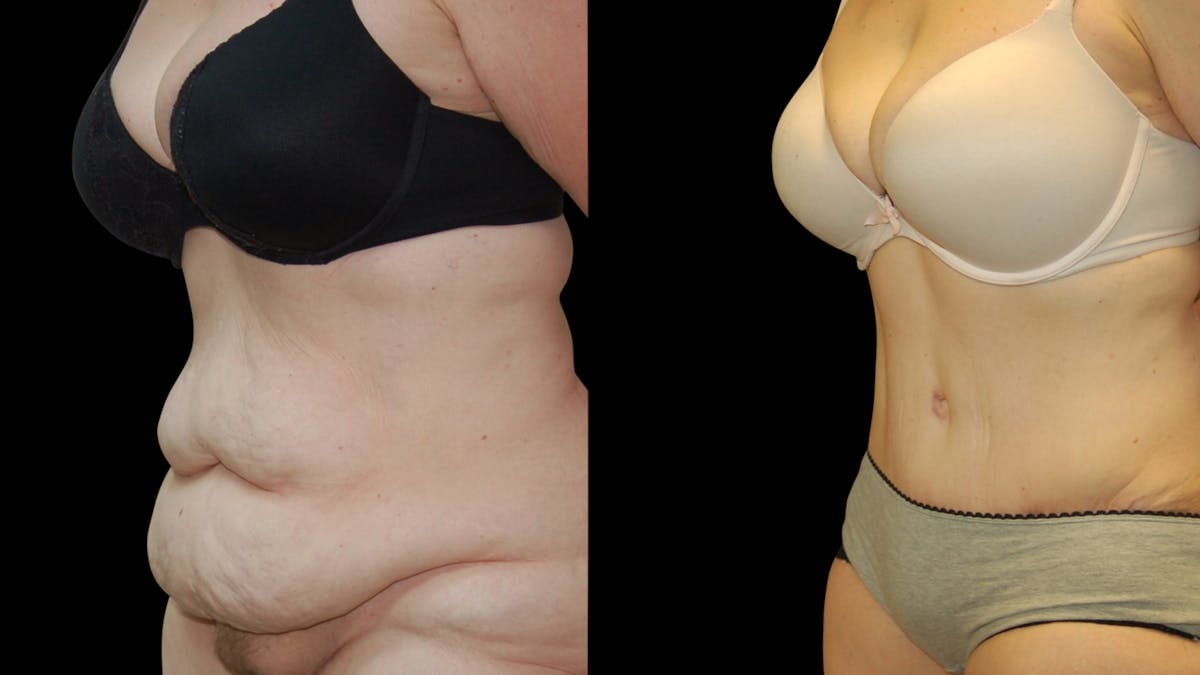 Tummy Tuck Before & After Gallery - Patient 352935 - Image 4