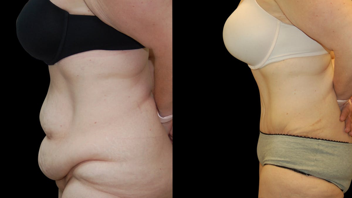 Tummy Tuck Before & After Gallery - Patient 352935 - Image 5