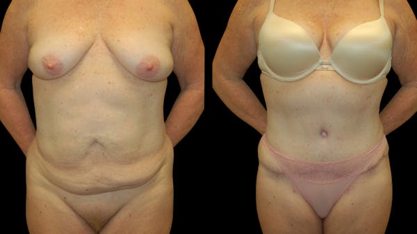 Tummy Tuck Before & After Gallery - Patient 283665 - Image 1