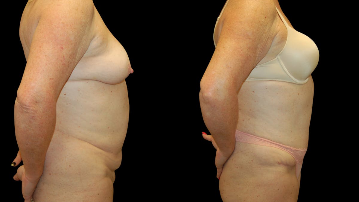 Tummy Tuck Before & After Gallery - Patient 283665 - Image 2