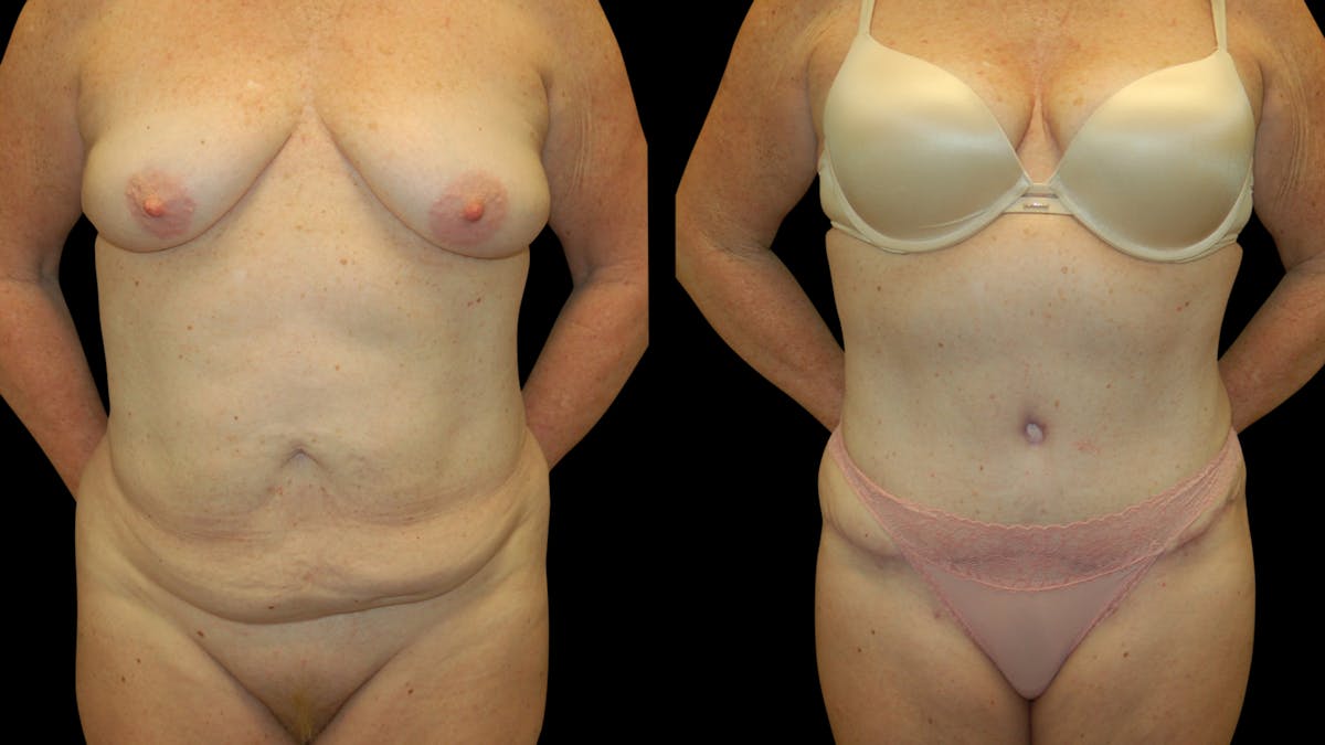 Tummy Tuck Before & After Gallery - Patient 283665 - Image 3