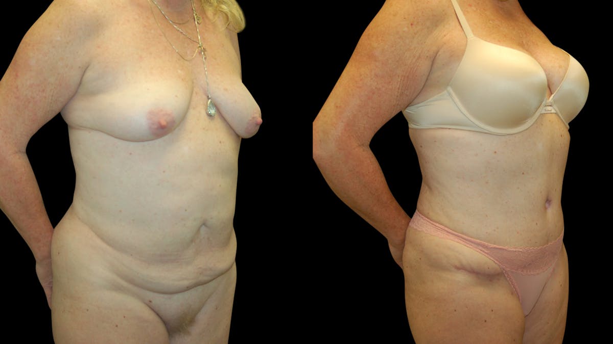 Tummy Tuck Before & After Gallery - Patient 283665 - Image 4