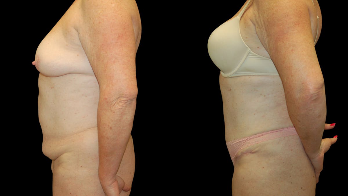 Tummy Tuck Before & After Gallery - Patient 283665 - Image 5