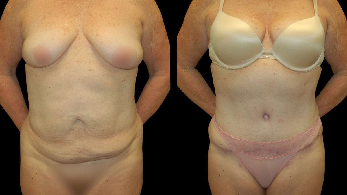 Tummy Tuck Before & After Gallery - Patient 283665 - Image 6