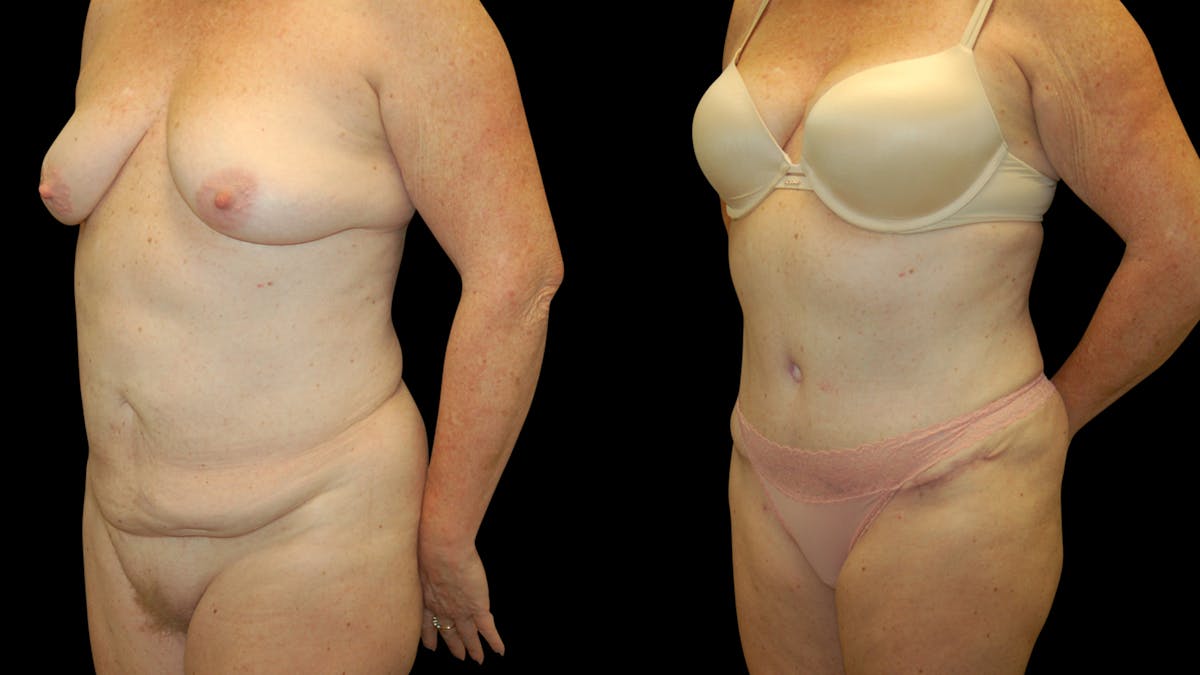 Tummy Tuck Before & After Gallery - Patient 283665 - Image 7